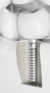 Dental Implants Services