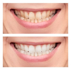 close-up of smile before and after teeth whitening
