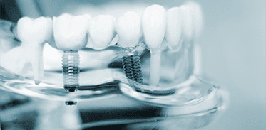 Dental Implants Image